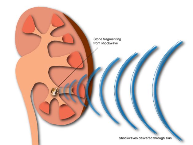 Điều trị sỏi tiết niệu không mổ – Tán sỏi ngoài cơ thể là gì?