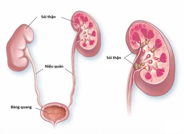 Điều trị sỏi tiết niệu như thế nào để đạt hiệu quả nhanh chóng