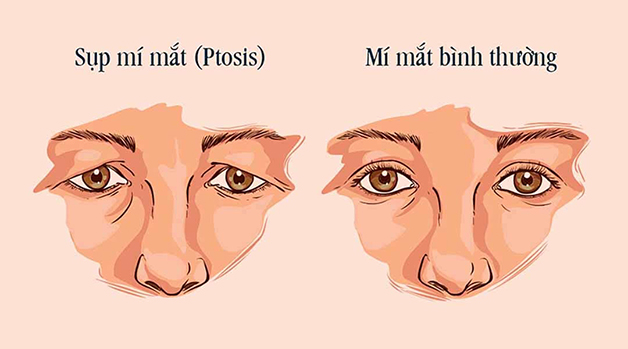 Điều trị sụp mí không cần phẫu thuật, bạn đã biết?