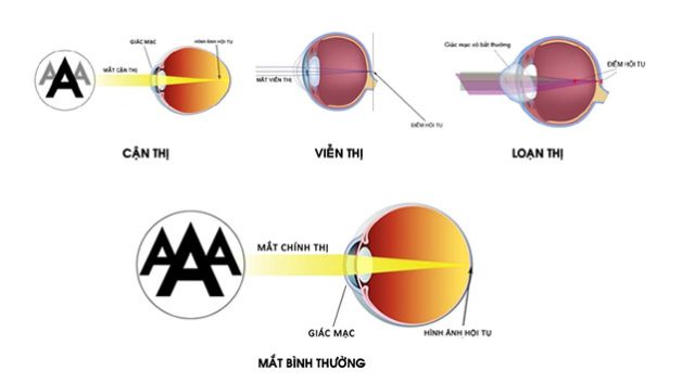 Điều trị tật khúc xạ mắt và những lưu ý quan trọng