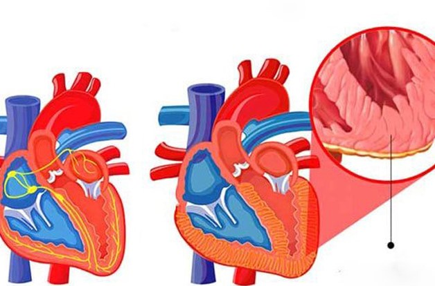 Điều trị thấp tim và cách phòng ngừa tái phát cần biết