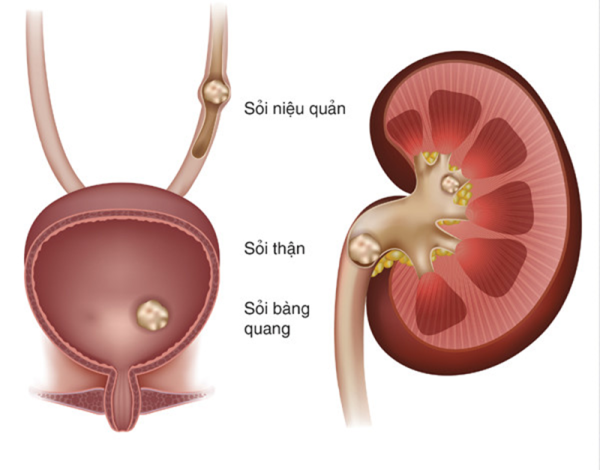 Điều trị thế nào khi bị sỏi đường tiết niệu?