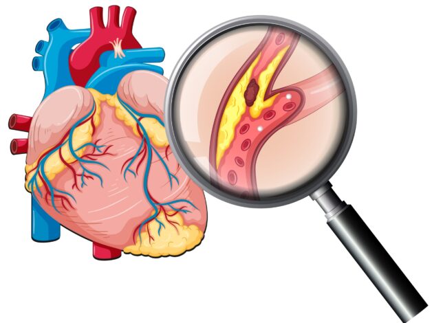 Điều trị thiếu máu cơ tim thế nào mới hiệu quả