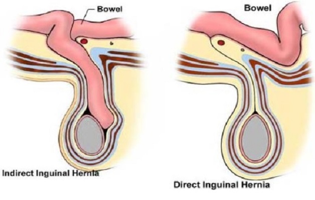 Điều trị thoát vị bẹn – thông tin cần biết