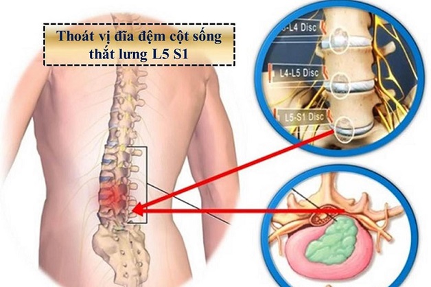 Điều trị thoát vị đĩa đệm chèn dây thần kinh