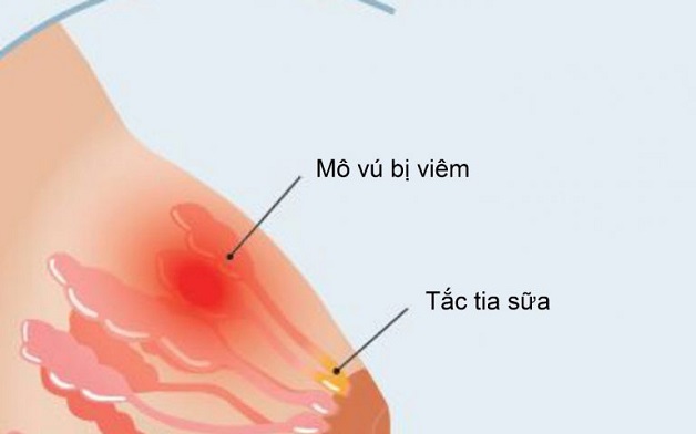 Điều trị thông tắc tia sữa bằng sóng siêu âm ở phụ nữ sau sinh