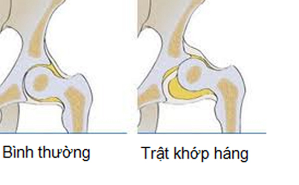 Điều trị trật khớp háng bẩm sinh ở trẻ em cần làm sớm