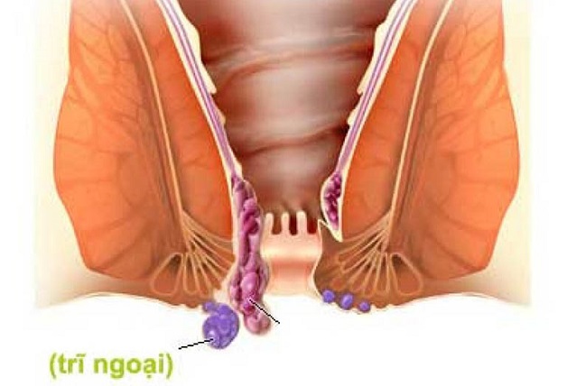 Điều trị trĩ ngoại độ 1 có cần hay không?