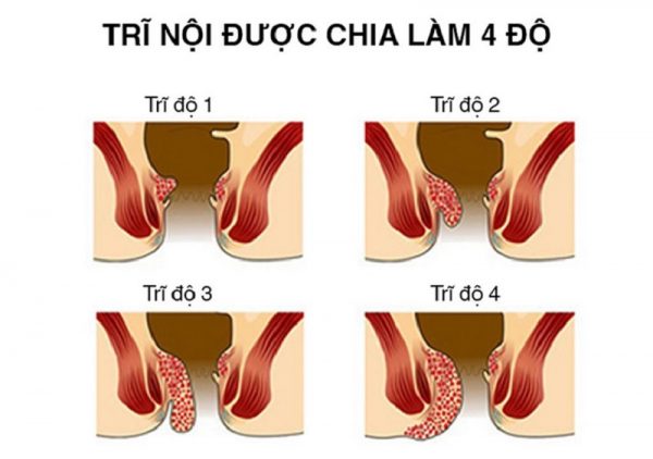 Điều trị trĩ nội theo từng cấp độ của bệnh