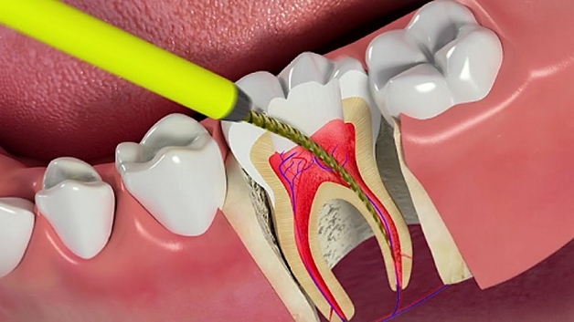 Điều trị tủy răng giá bao nhiêu tiền và quy trình thực hiện