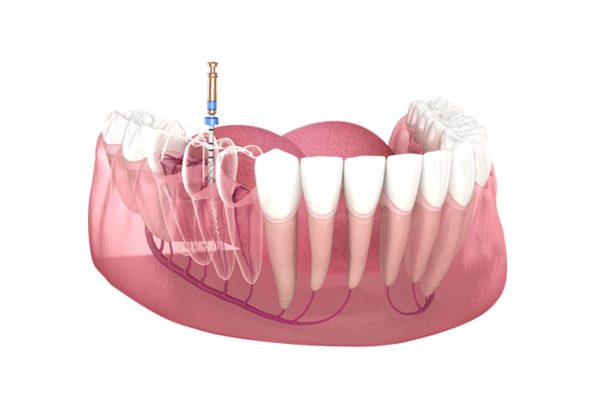 Điều trị tủy răng như thế nào đúng cách?