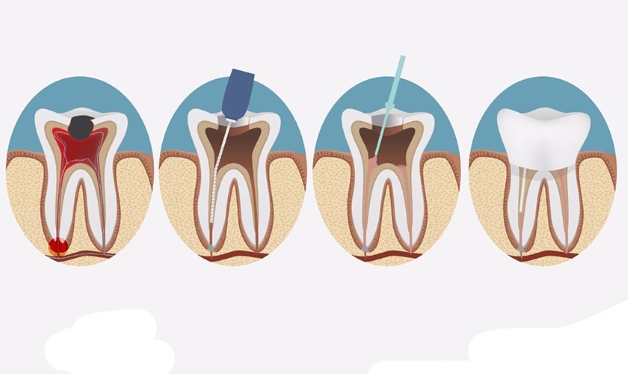 Điều trị tủy răng ở đâu tốt và các tiêu chí