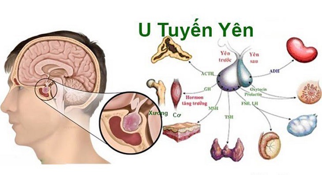 Điều trị u tuyến yên và những điều cần biết