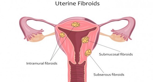Điều trị u xơ cổ tử cung thế nào?