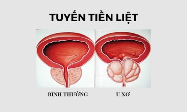 Điều trị u xơ tuyến tiền liệt bằng những phương pháp nào?