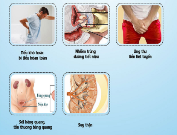 Điều trị u xơ tuyến tiền liệt bằng những phương pháp nào?