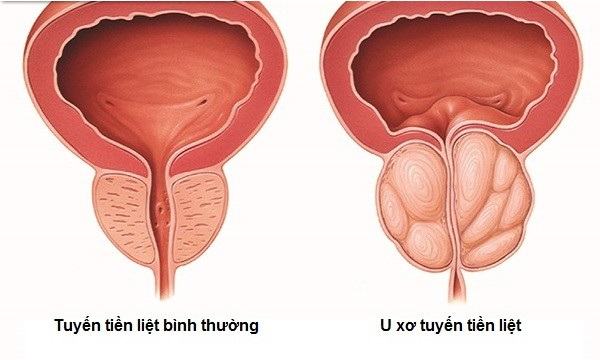 Điều trị u xơ tuyến tiền liệt