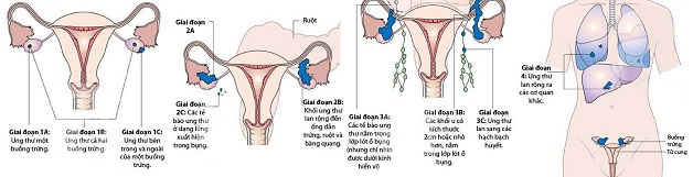 Điều trị ung thư buồng trứng biểu mô xâm lấn theo giai đoạn