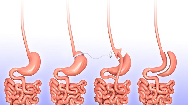 Điều trị ung thư dạ dày ở đâu tốt nhất? Phương pháp điều trị