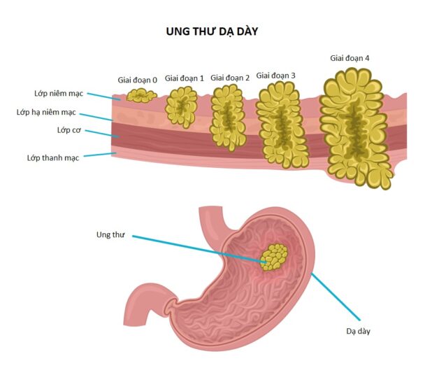 Điều trị ung thư dạ dày theo giai đoạn bệnh