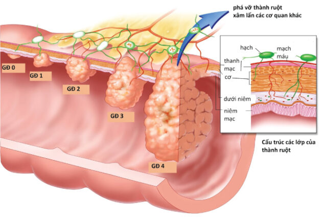 Điều trị ung thư đại tràng các giai đoạn