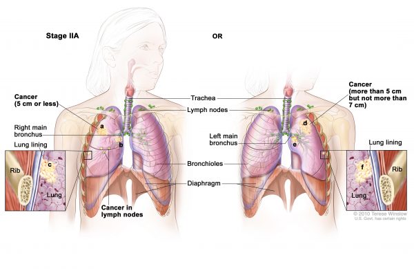 Điều trị ung thư phổi giai đoạn 2