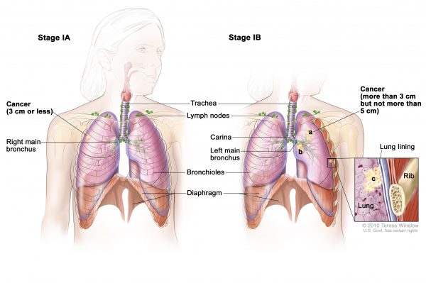 Điều trị ung thư phổi giai đoạn đầu