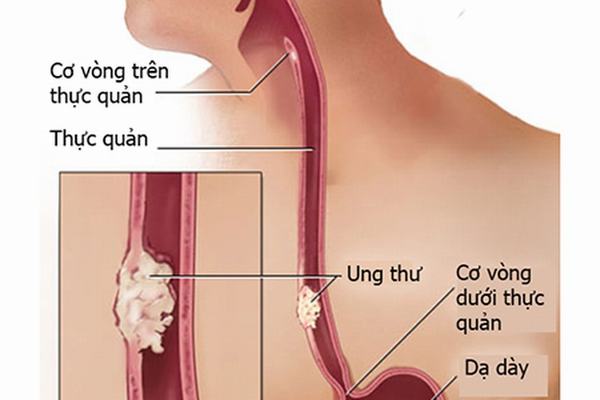 Điều trị ung thư thực quản di căn