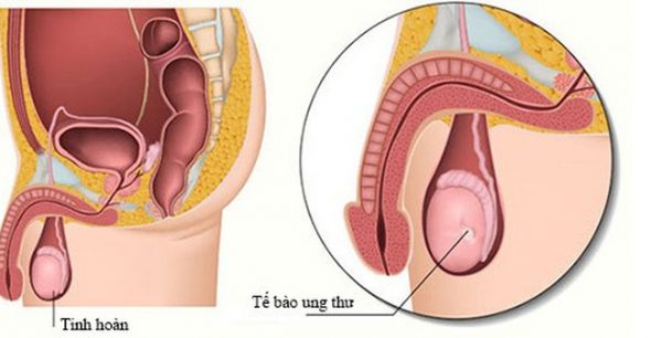 Điều trị ung thư tinh hoàn