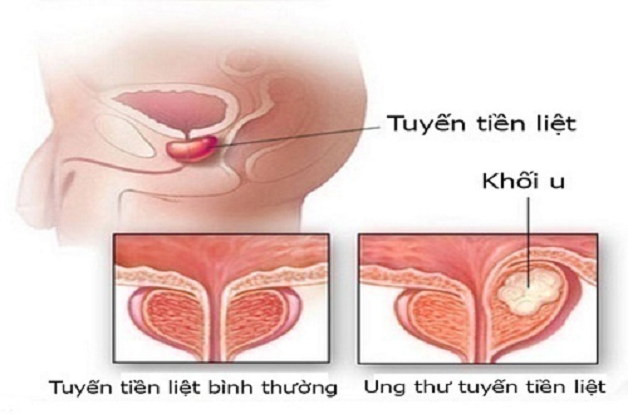 Điều trị ung thư tuyến tiền liệt và những điều cần biết