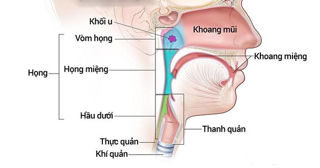 Điều trị ung thư vòm họng giai đoạn đầu và cách chẩn đoán