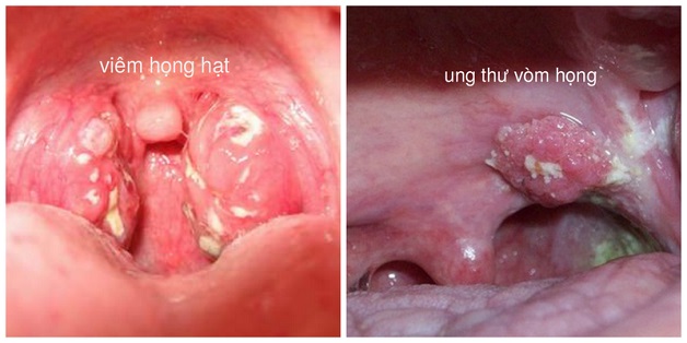 Điều trị ung thư vòm họng hết bao nhiêu tiền