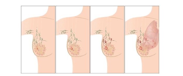 Điều trị ung thư vú giai đoạn I-II-III