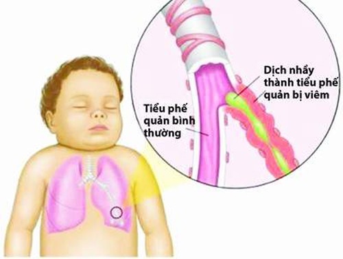 Điều trị và phòng ngừa bệnh viêm tiểu phế quản ở trẻ