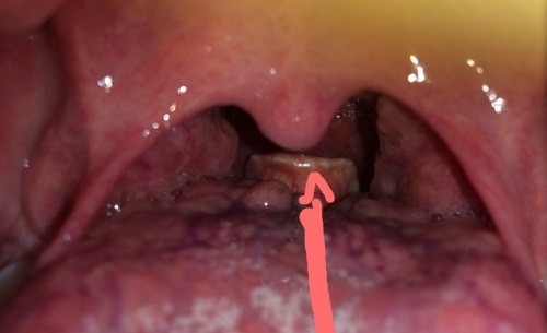 Điều trị viêm amidan cấp kịp thời, triệt để nhanh chóng