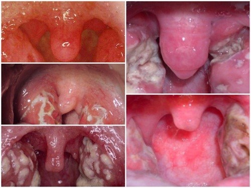 Điều trị viêm amidan mạn tính thế nào hiệu quả