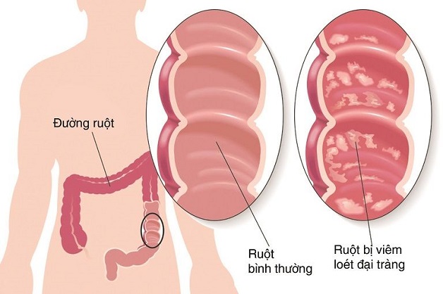 Điều trị viêm đại tràng xuất huyết