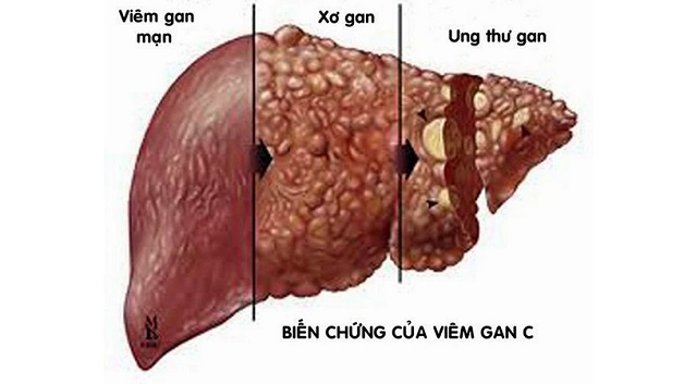 Điều trị viêm gan C như thế nào?