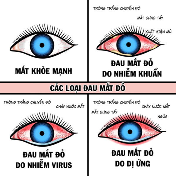 Điều trị viêm kết mạc, khó hay dễ?