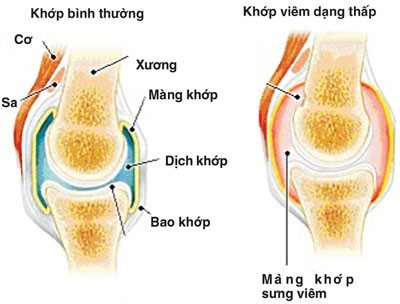 Điều trị viêm khớp dạng thấp hiệu quả ở Bệnh Viện Thu Cúc