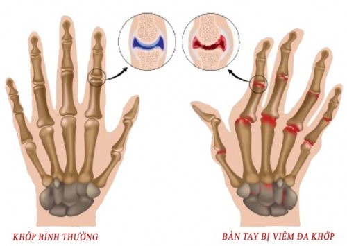 Điều trị viêm khớp dạng thấp như thế nào?