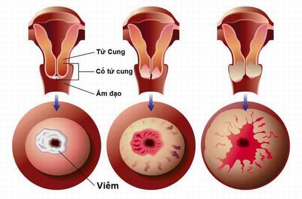 Điều trị viêm lộ tuyến cổ tử cung ở đâu?