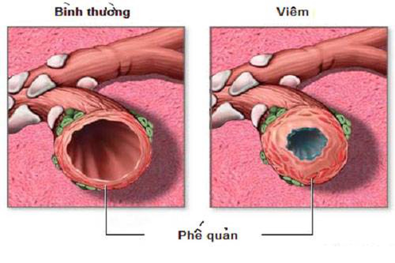 Điều trị viêm phế quản cấp và những lưu ý quan trọng