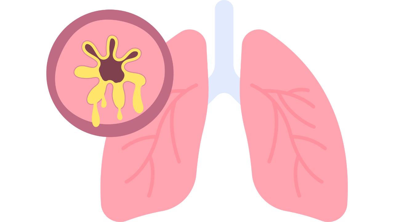 Điều trị viêm phế quản cho trẻ nhỏ: Chuyên gia hướng dẫn