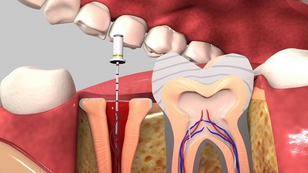 Điều trị viêm quanh cuống răng thế nào?