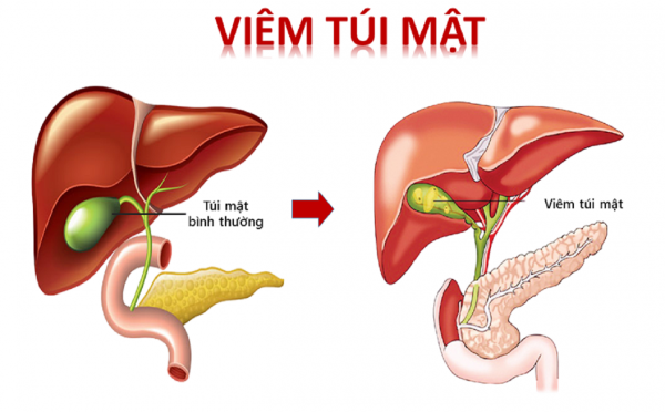 Điều trị viêm túi mật có những phương pháp nào?