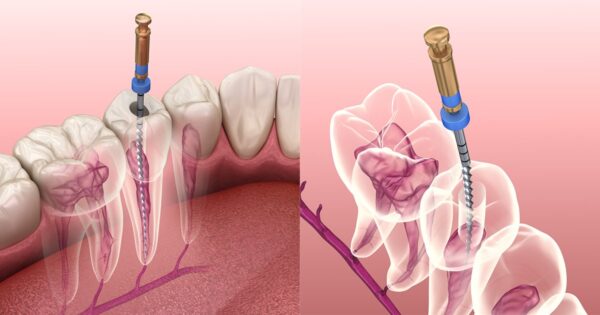 Điều trị viêm tủy răng bao nhiêu tiền và quy trình thực hiện