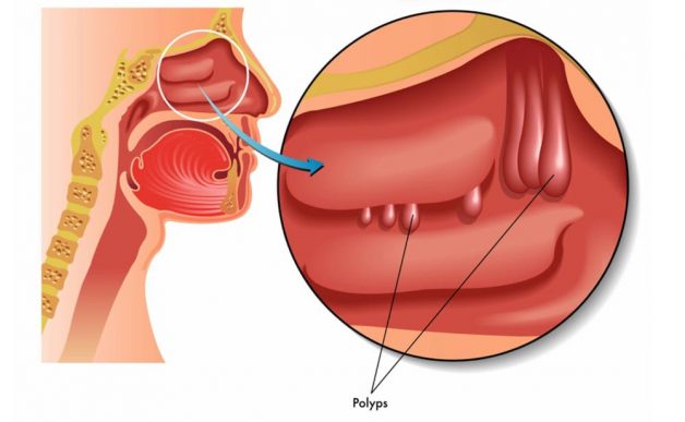 Điều trị viêm xoang trán có cần thiết phải phẫu thuật?