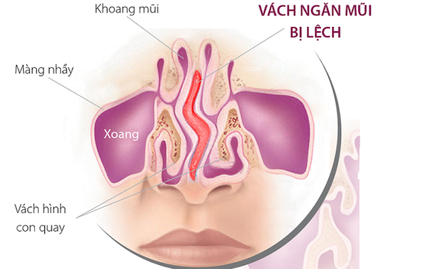 Điều trị viêm xoang trán thế nào cho hiệu quả?