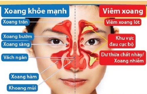 Điều trị viêm xoang